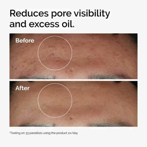 The Ordinary Niacinamide 10 percent + Zinc 1 percent – Acne & Oil Control